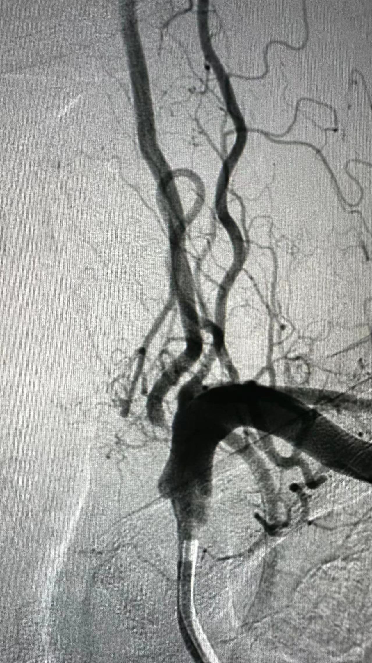 脑血管造影术 支架置入术  市医院老年病科专家团队顺利解决和大爷的“头”等大事 (4).jpg