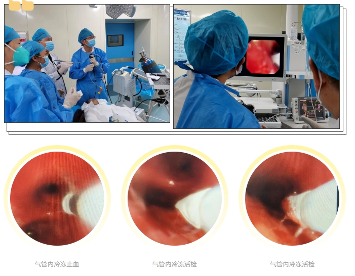 首例！丽江市人民医院呼吸与危重症医学科开展内镜四级手术——支气管镜下冷冻技术1.png