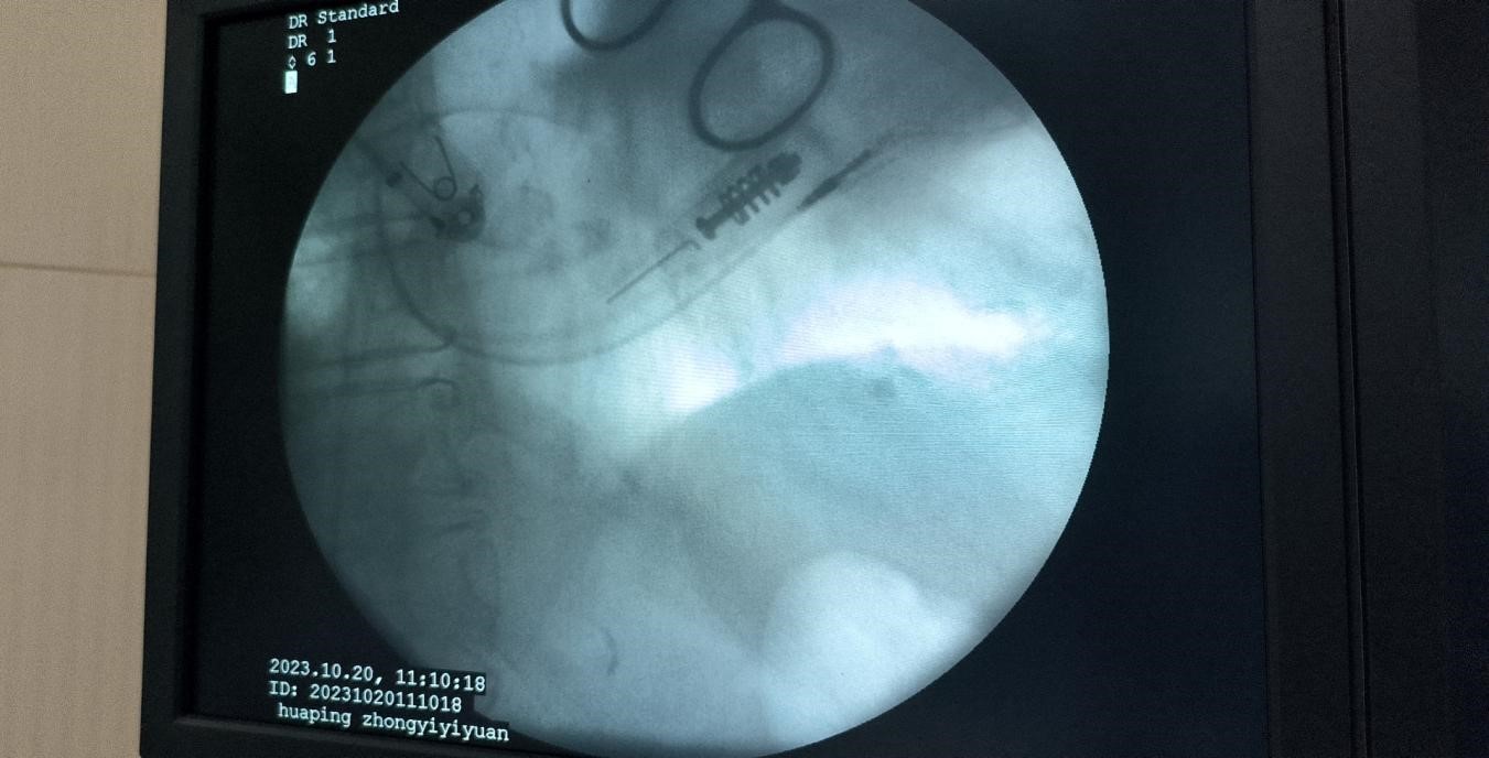 “心”的突破—华坪县中医医院成功开展首例永久心脏双腔起搏器植入术 (3).jpg