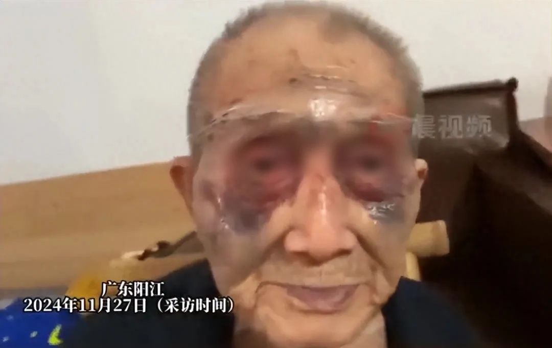 广东阳西通报“老人疑遭护工长期殴打”：系摔倒受伤，排除他人殴打1.jpg